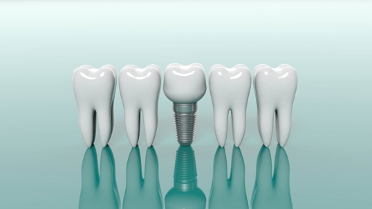 Dental Implants
